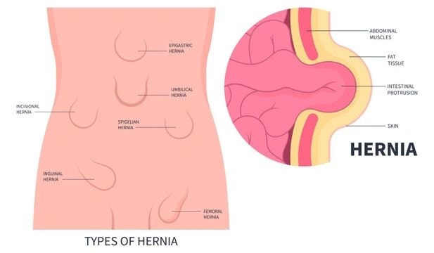 Types of hernia anatomical diagram